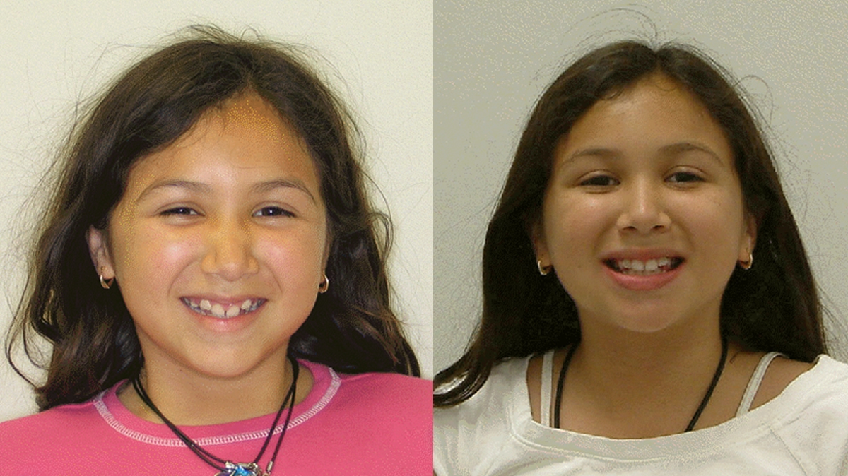 兒童牙齒矯正矯正對照圖