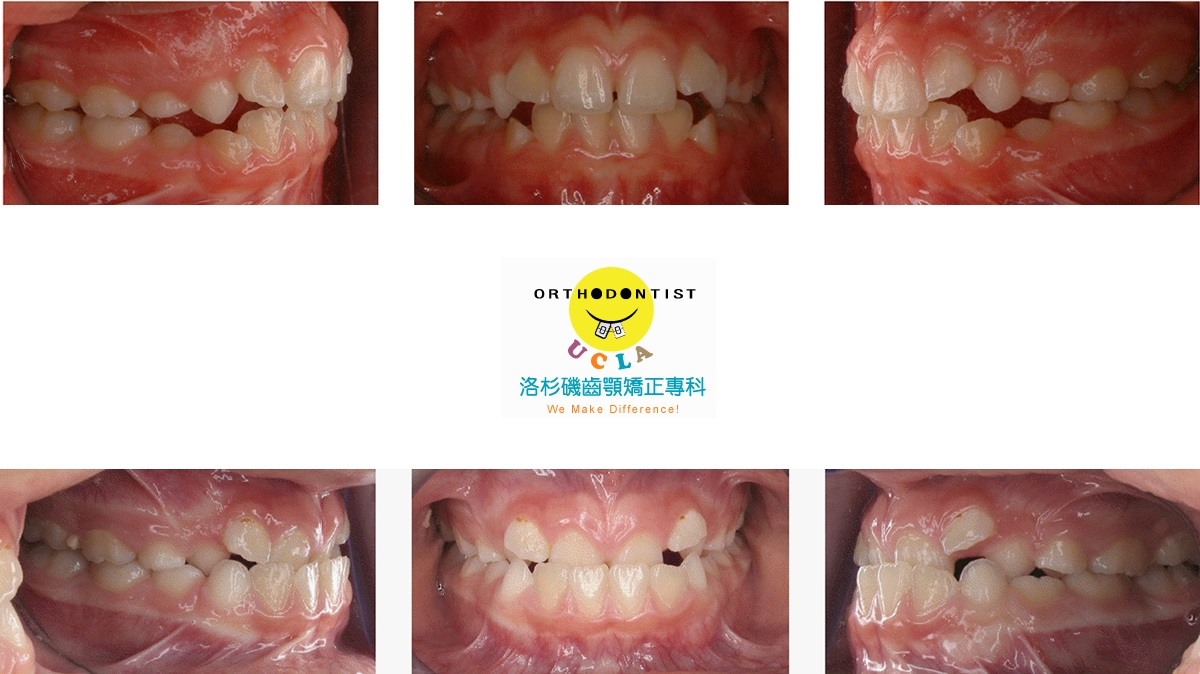 兒童牙齒矯正矯正對照圖二