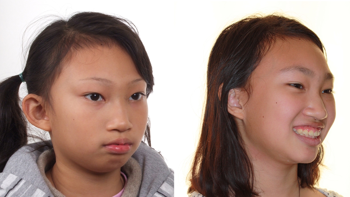 兒童牙齒矯正矯正對照圖二