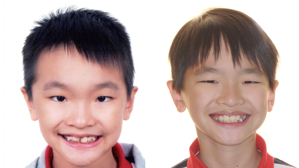 兒童牙齒矯正矯正對照圖