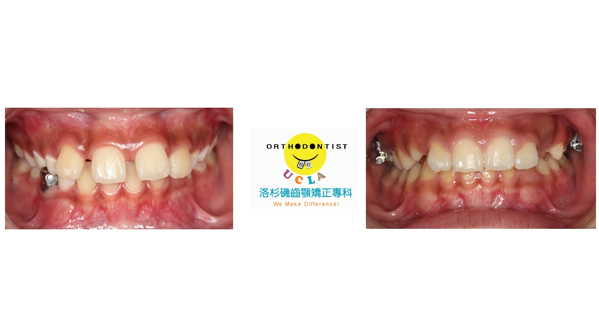 兒童牙齒矯正矯正對照圖二