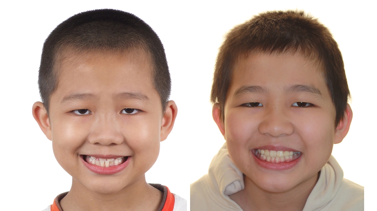 兒童牙齒矯正矯正對照圖