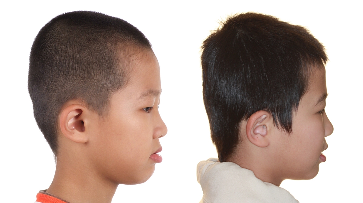 兒童牙齒矯正矯正對照圖二