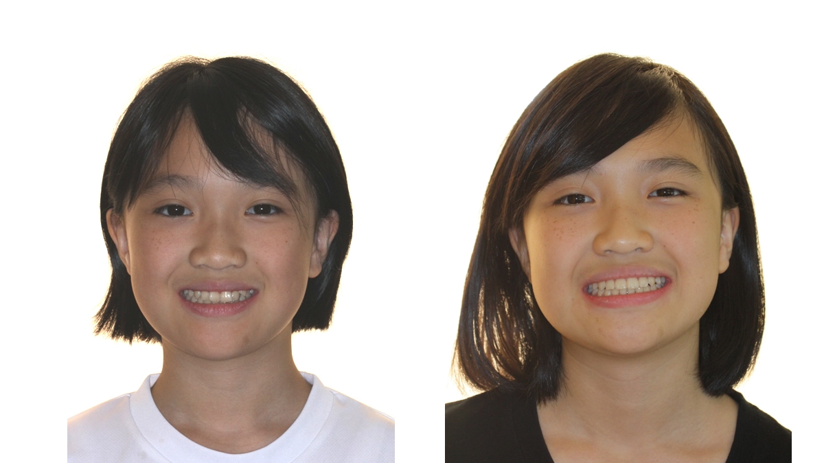 兒童牙齒矯正矯正對照圖