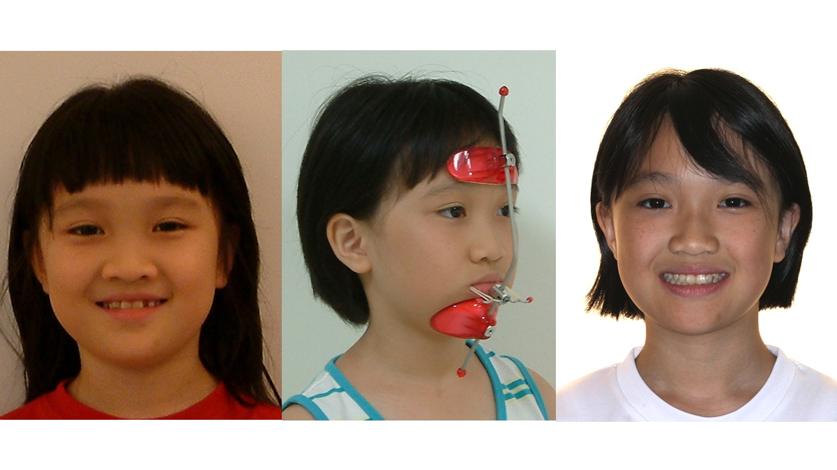 兒童牙齒矯正矯正對照圖二