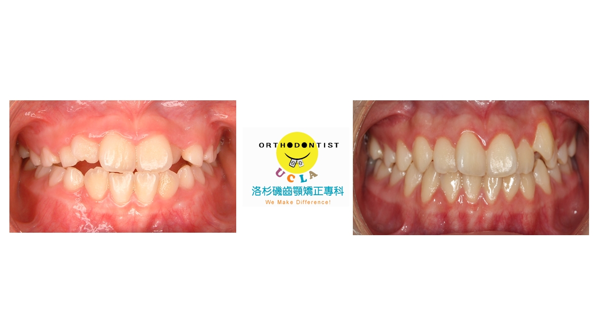 兒童牙齒矯正矯正對照圖三