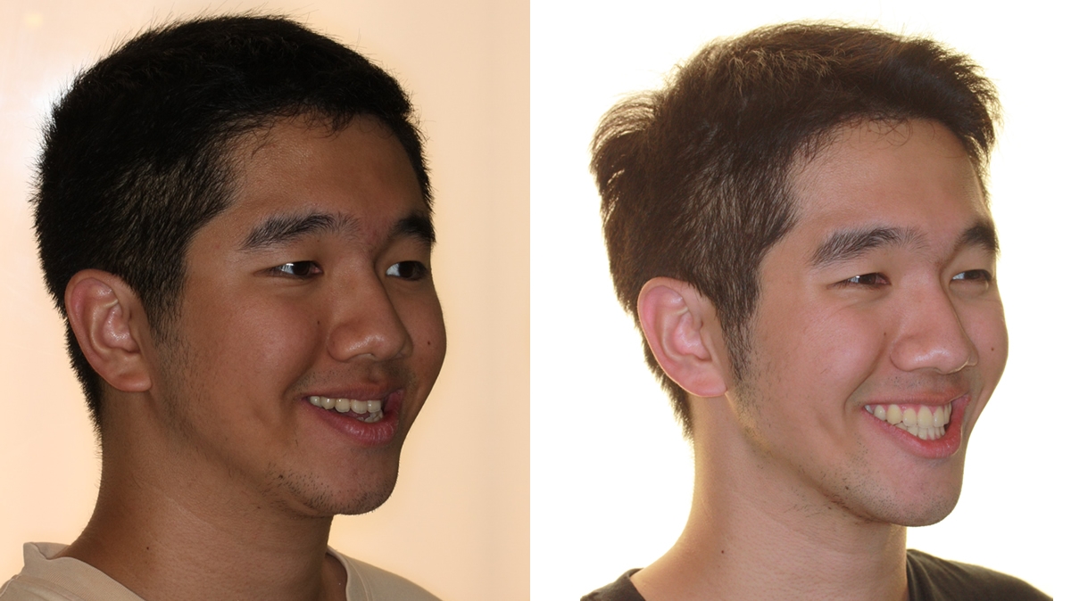 戽斗牙齒矯正對照圖二