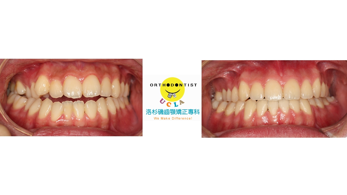 戽斗牙齒矯正對照圖三
