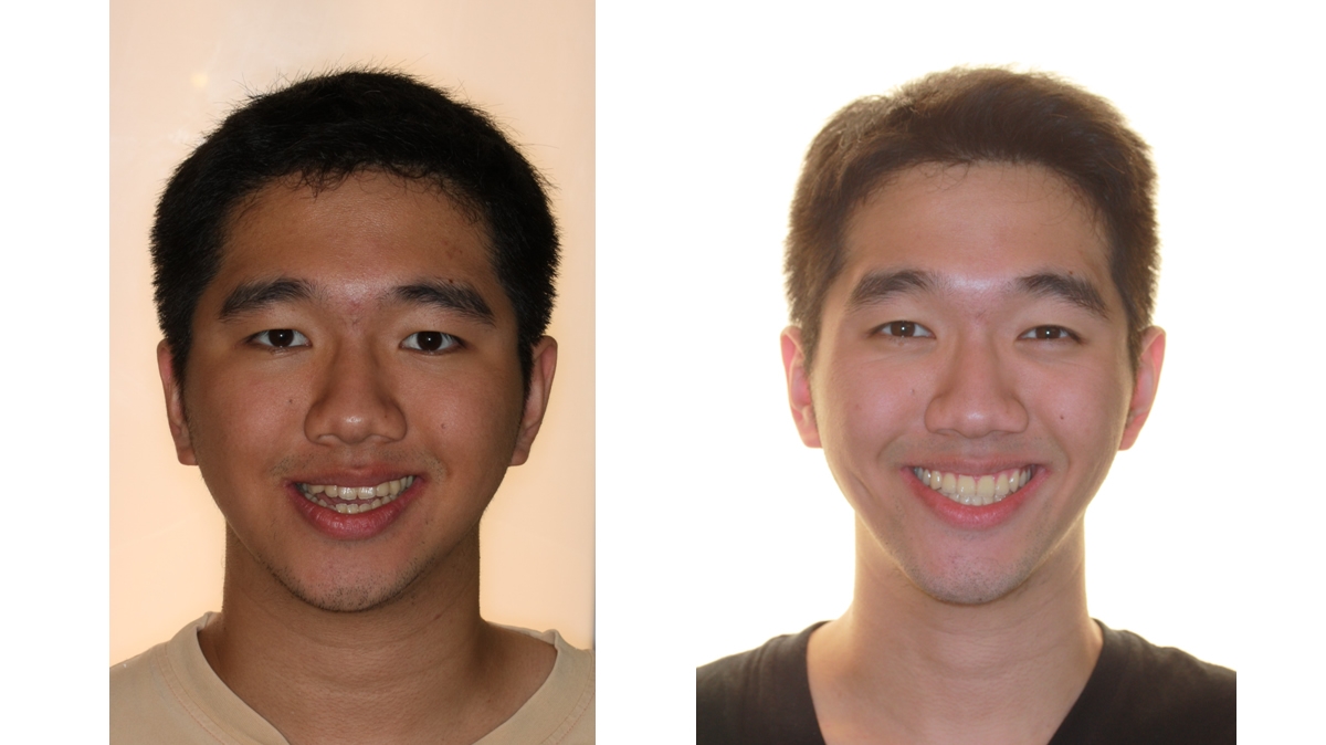 戽斗牙齒矯正對照圖