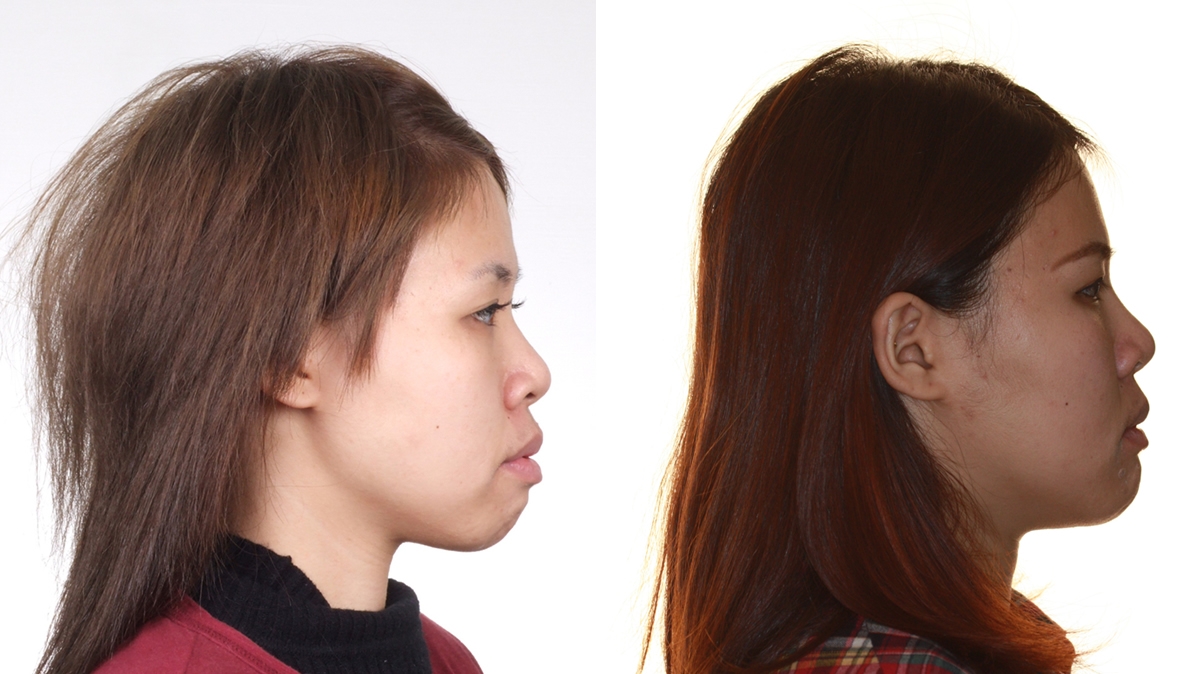 戽斗牙齒矯正對照圖二