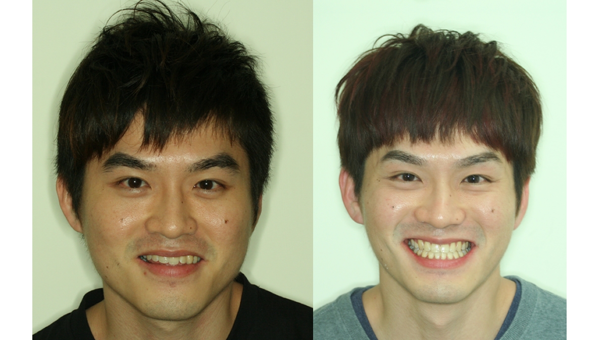 戽斗牙齒矯正對照圖