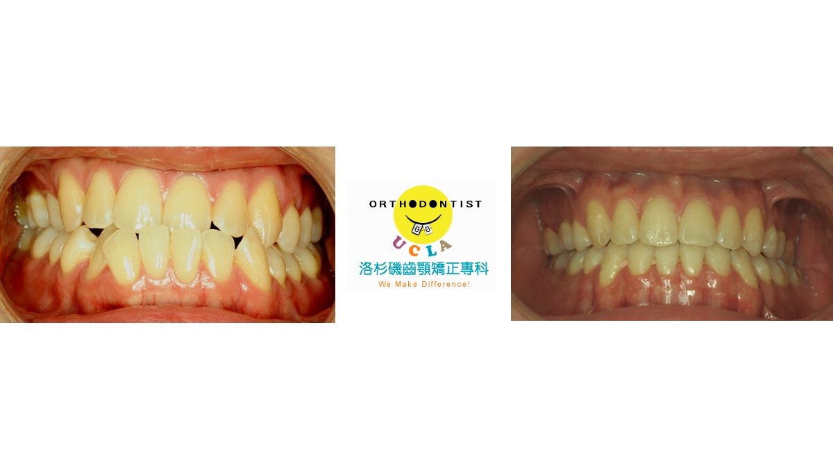 戽斗牙齒矯正對照圖三