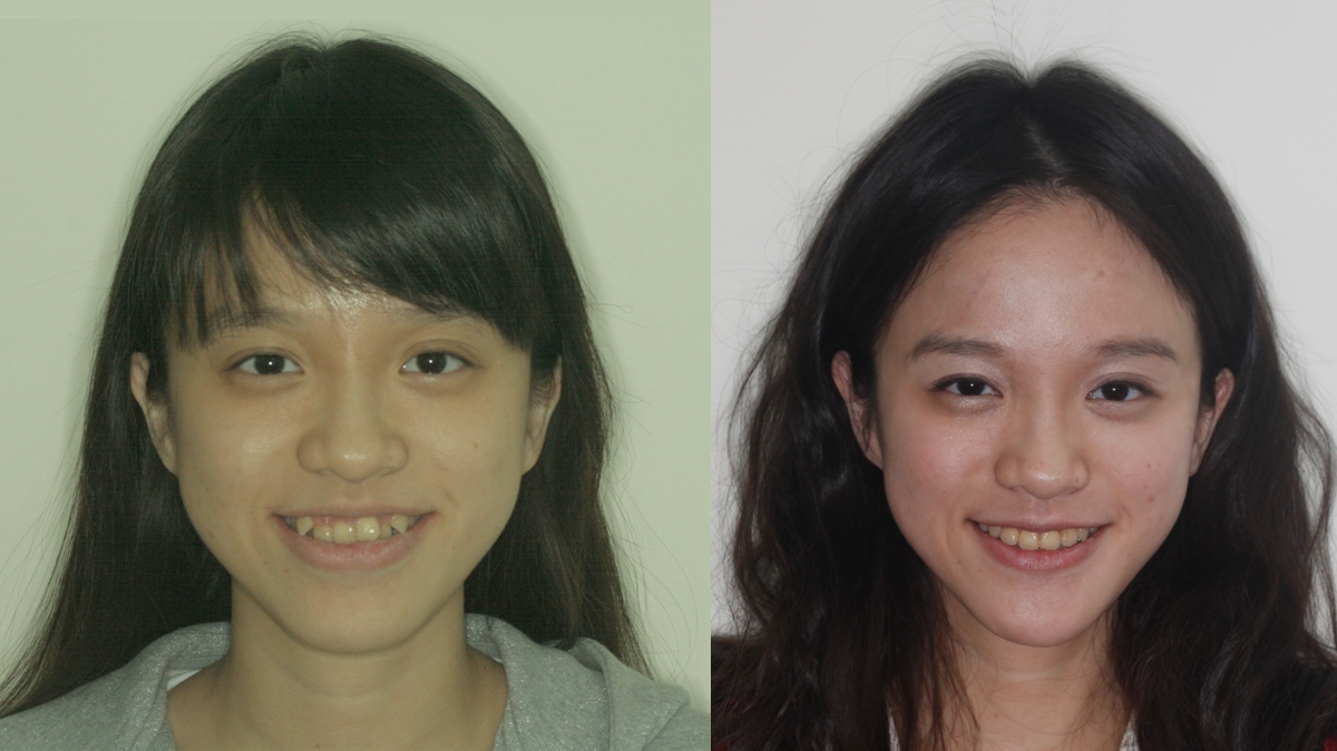 戽斗牙齒矯正對照圖