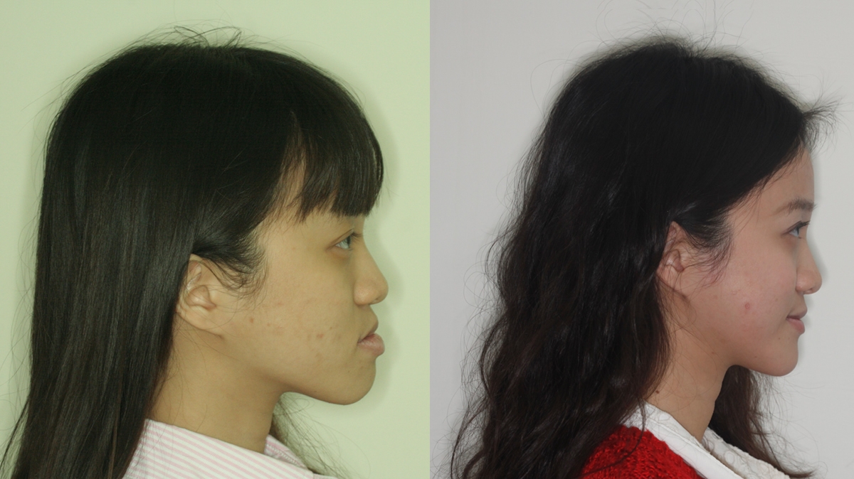 戽斗牙齒矯正對照圖二