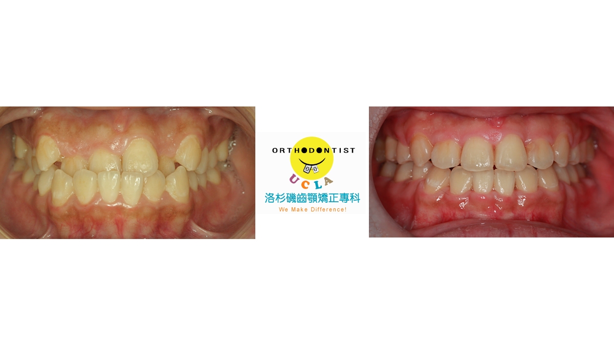 戽斗牙齒矯正對照圖三