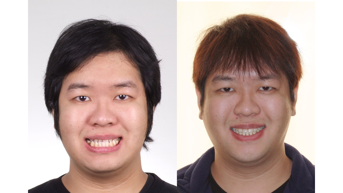 戽斗牙齒矯正對照圖