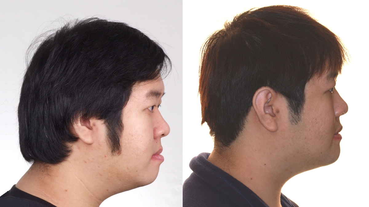 戽斗牙齒矯正對照圖二