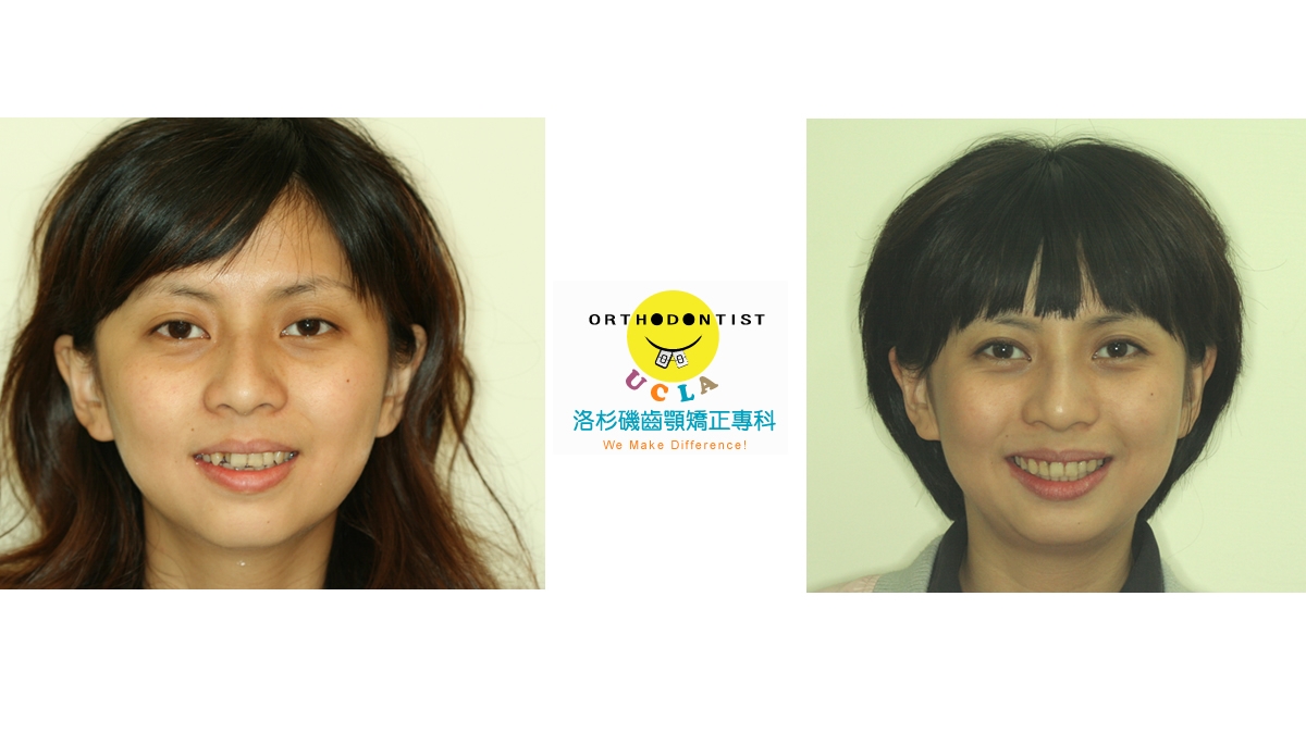 混亂擁擠牙齒矯正對照圖
