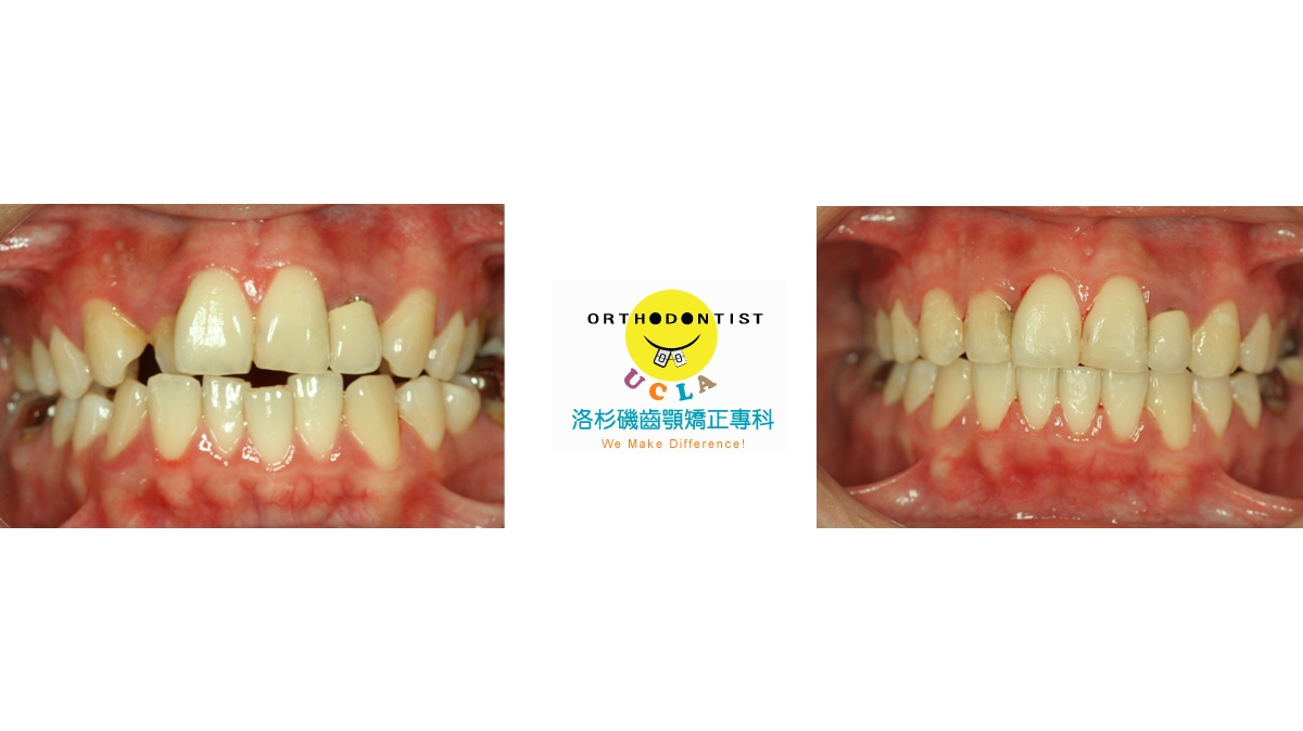 混亂擁擠牙齒矯正對照圖二