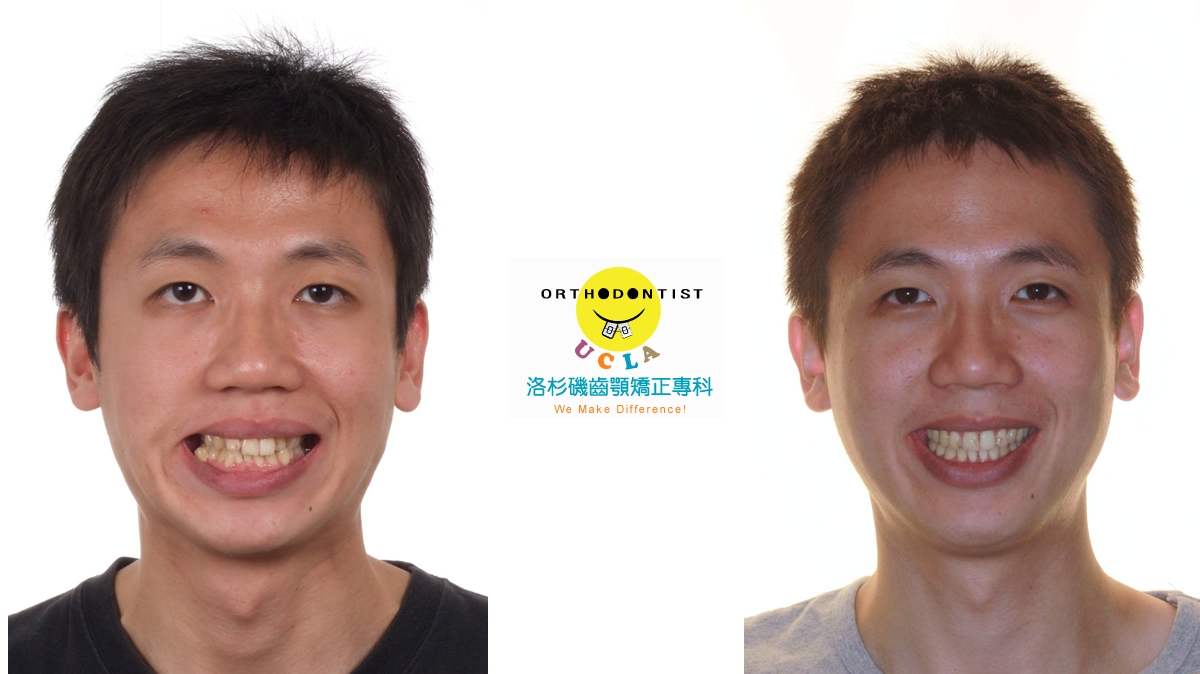 混亂擁擠牙齒矯正對照圖