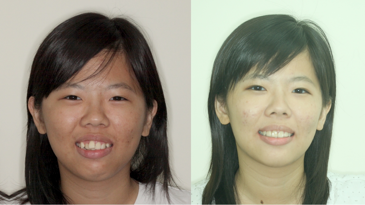 混亂擁擠牙齒矯正對照圖