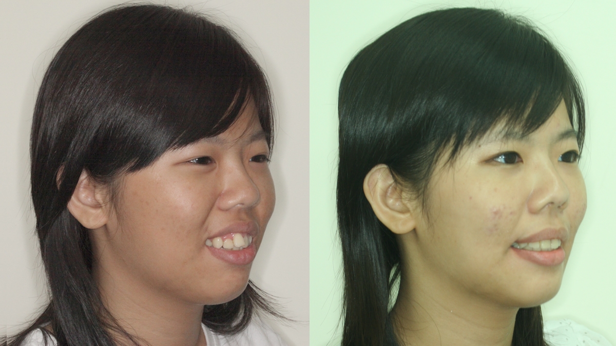 混亂擁擠牙齒矯正對照圖二