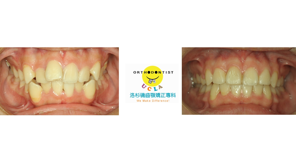 混亂擁擠牙齒矯正對照圖三