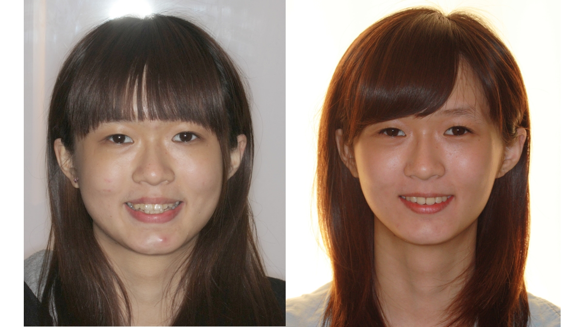 混亂擁擠牙齒矯正對照圖