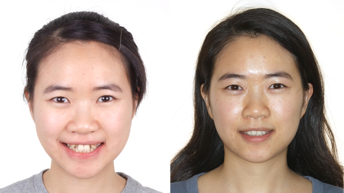 混亂擁擠牙齒矯正對照圖