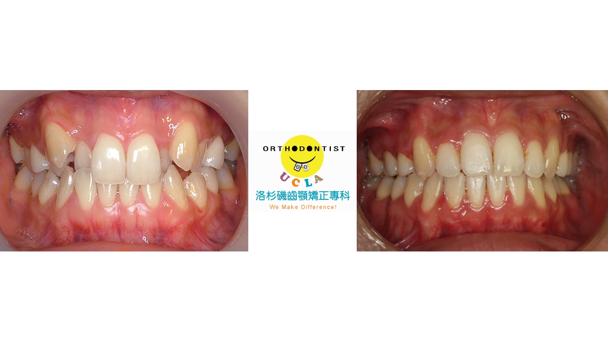 混亂擁擠牙齒矯正對照圖二