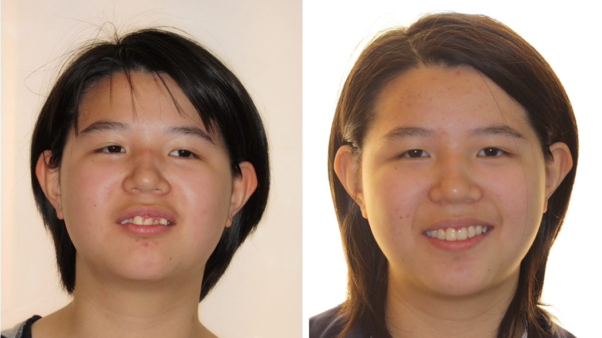 混亂擁擠牙齒矯正對照圖