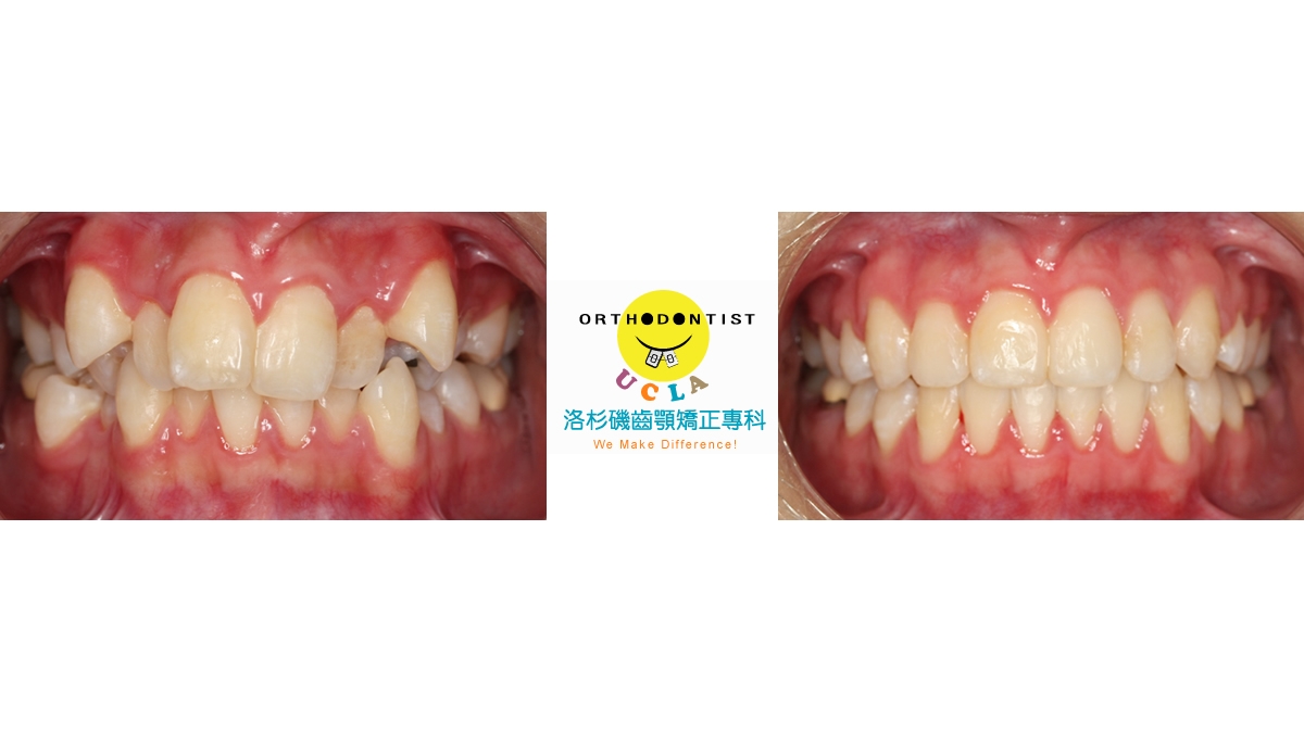 混亂擁擠牙齒矯正對照圖三