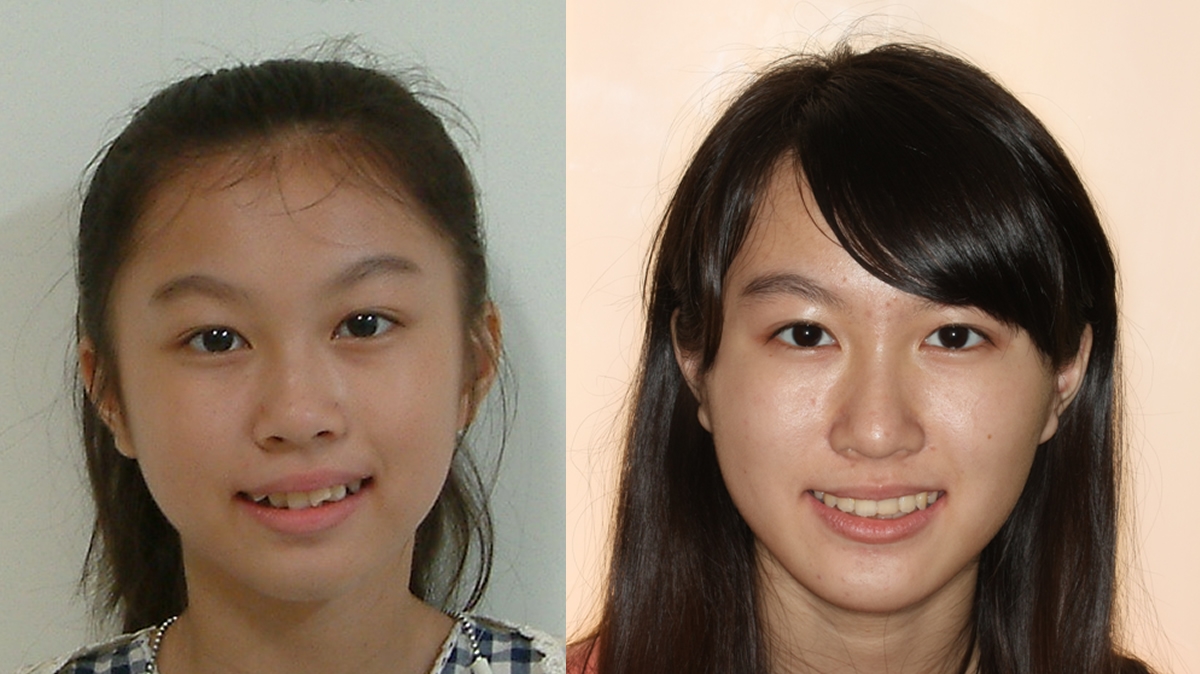 混亂擁擠牙齒矯正對照圖