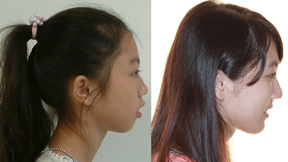 混亂擁擠牙齒矯正對照圖二