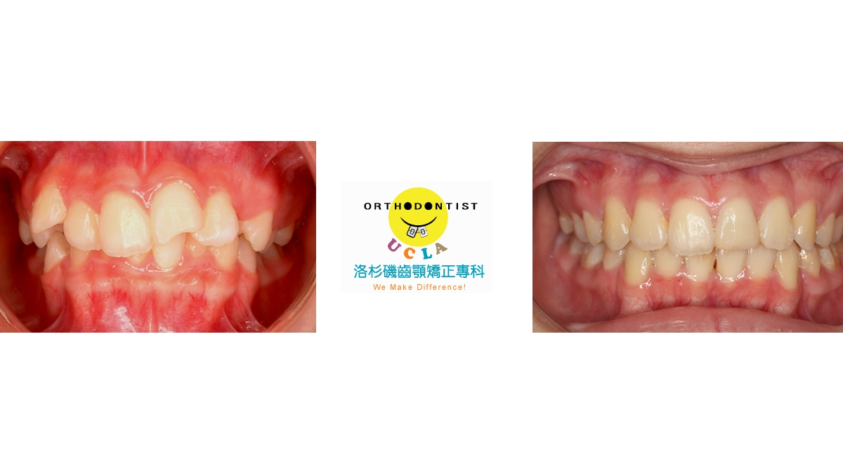 混亂擁擠牙齒矯正對照圖三