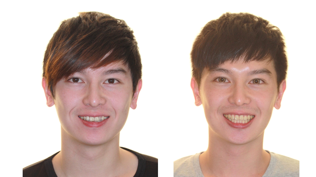 混亂擁擠牙齒矯正對照圖