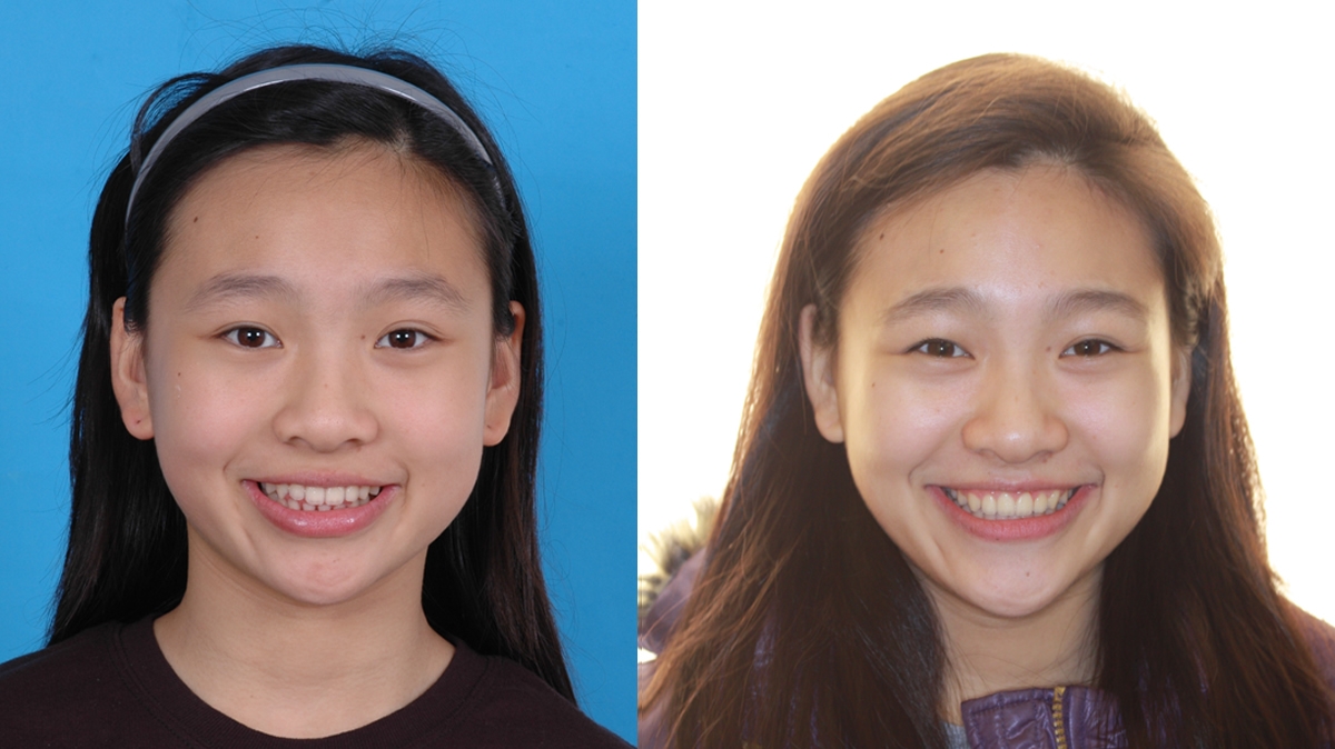 漏風牙齒矯正對照圖