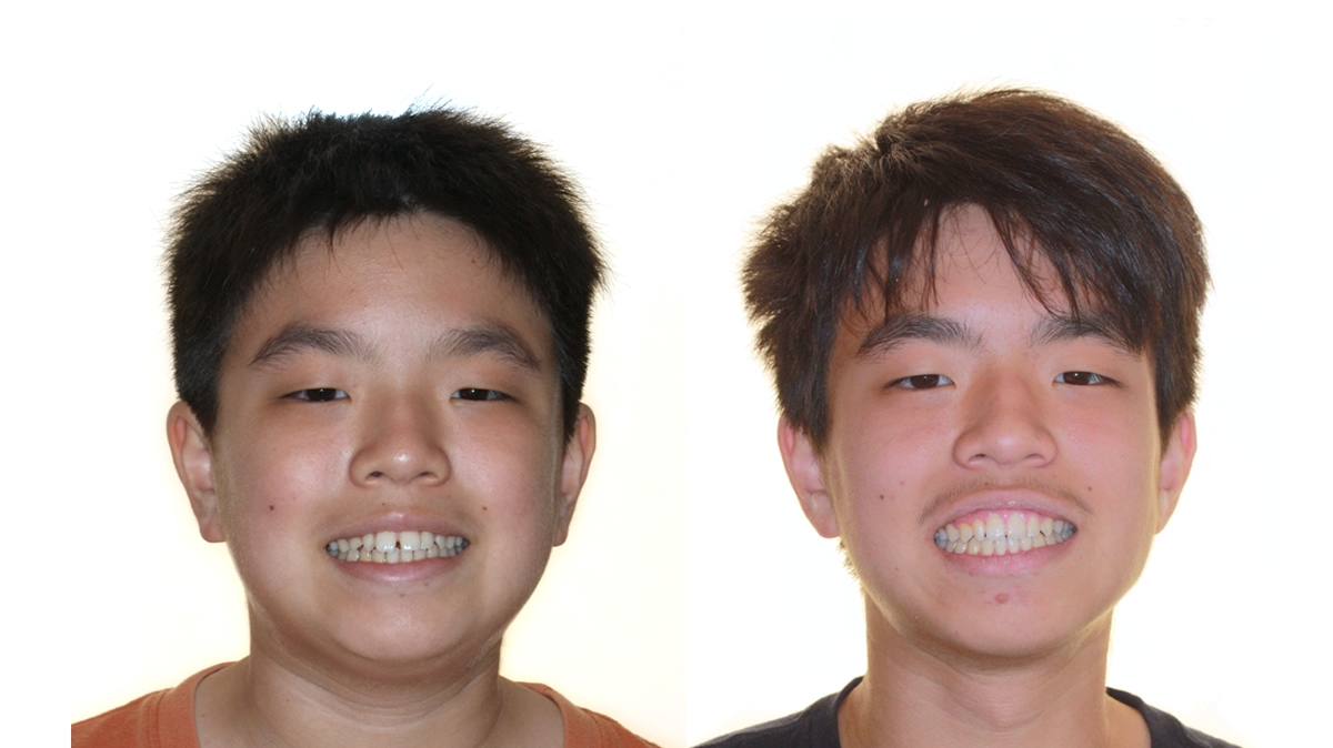 漏風牙齒矯正對照圖