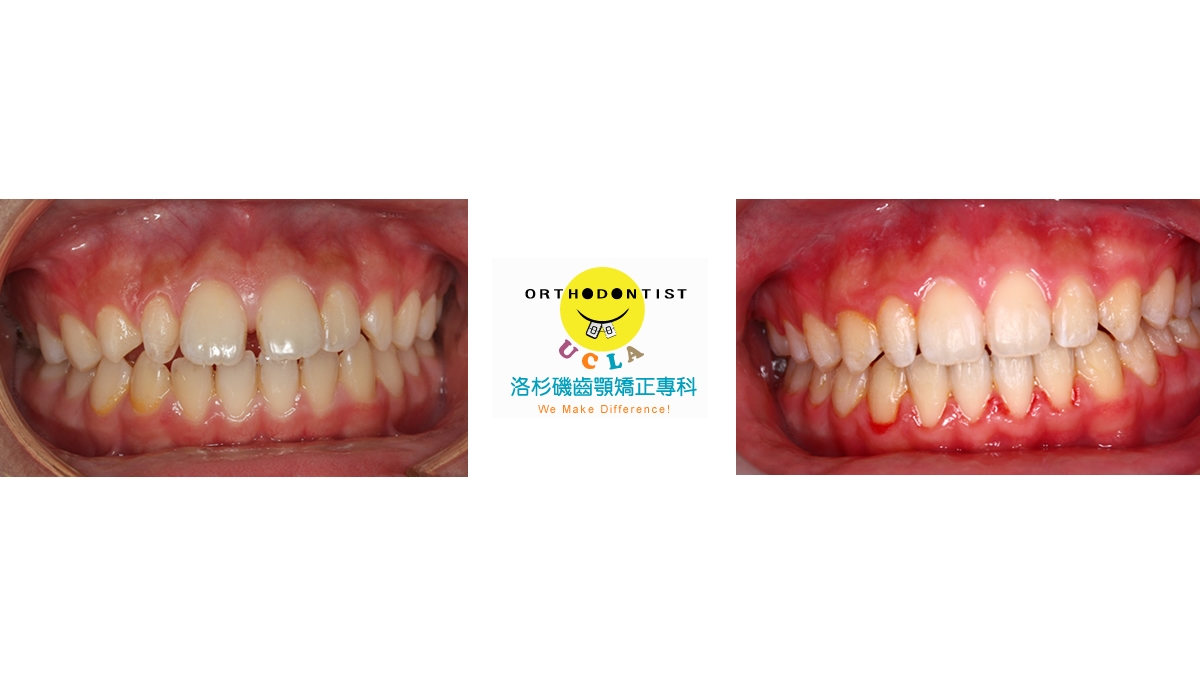 漏風牙齒矯正對照圖二