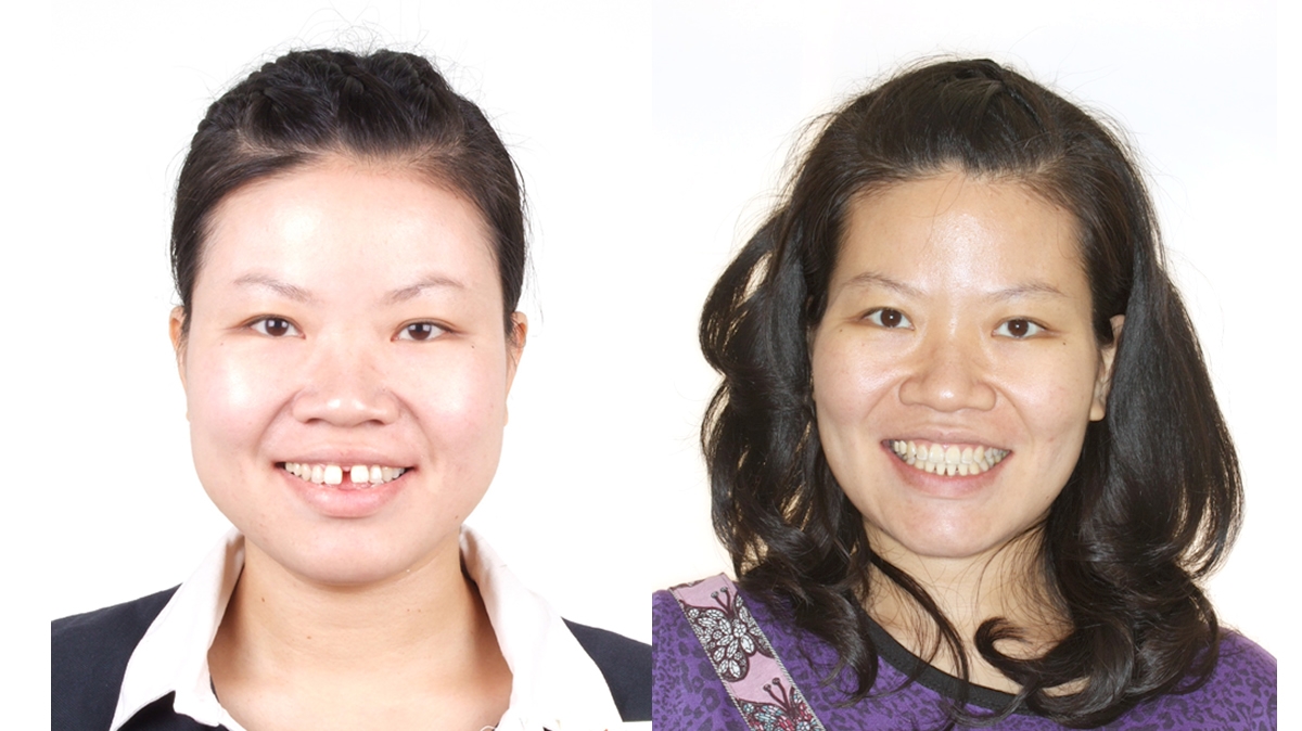 漏風牙齒矯正對照圖