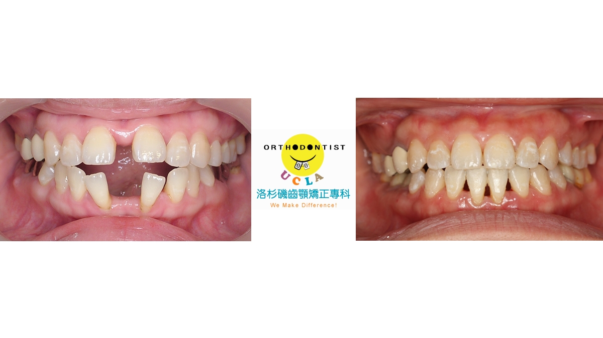 漏風牙齒矯正對照圖二