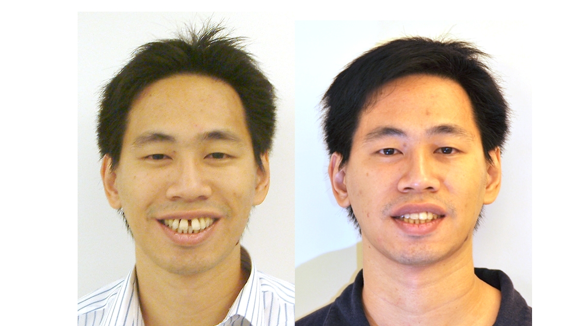 漏風牙齒矯正對照圖