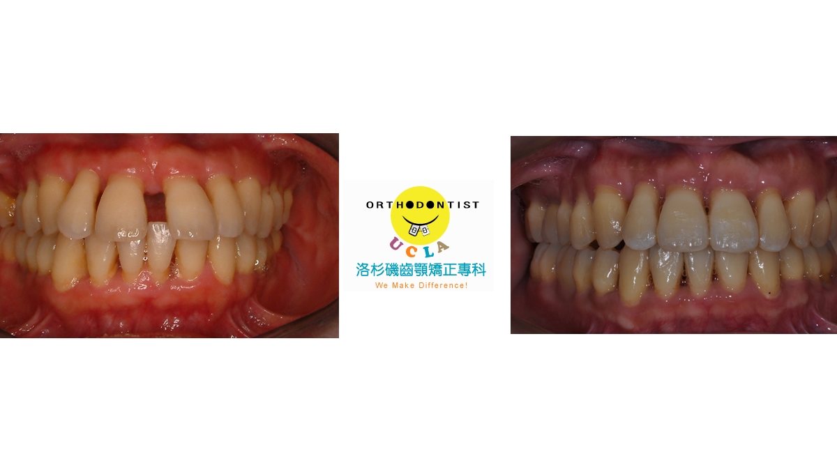 漏風牙齒矯正對照圖二