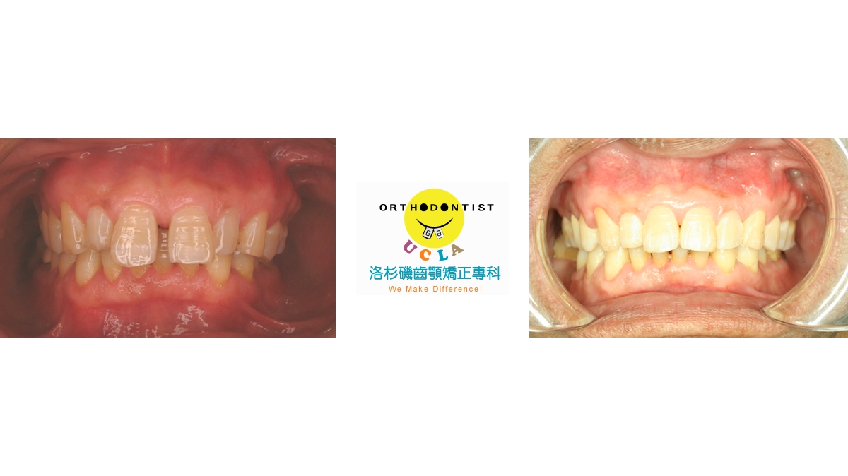 漏風牙齒矯正對照圖二