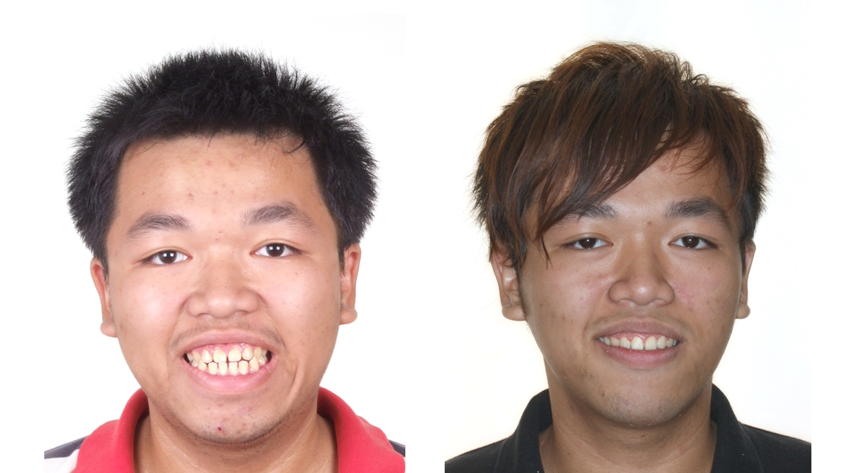 漏風牙齒矯正對照圖