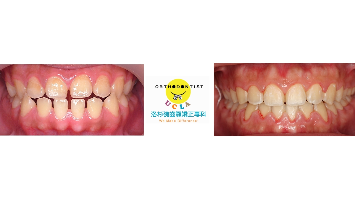 漏風牙齒矯正對照圖二
