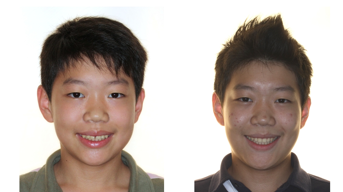 漏風牙齒矯正對照圖