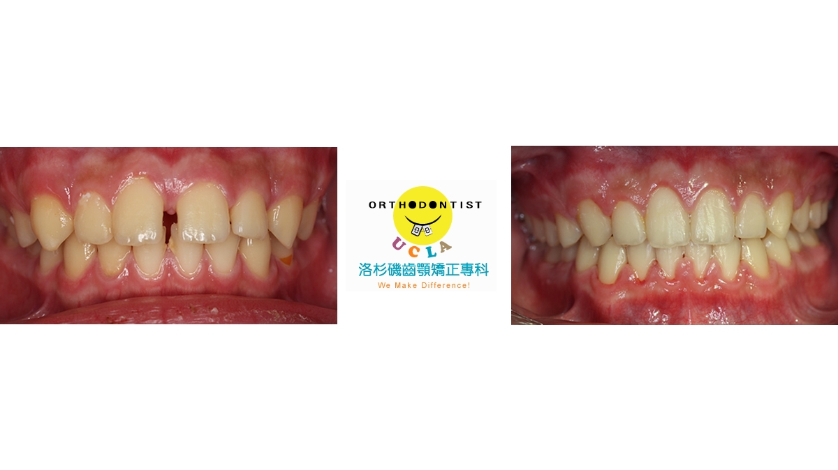 漏風牙齒矯正對照圖二