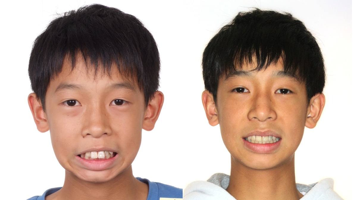 暴牙牙齒矯正對照圖