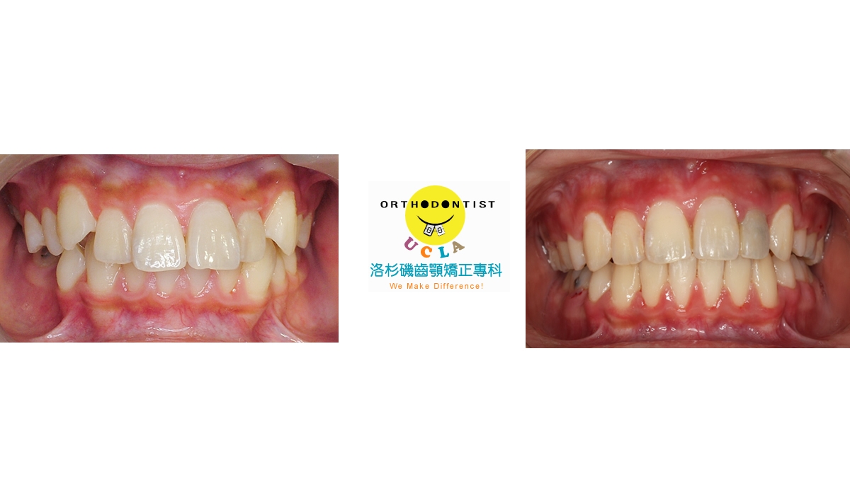 暴牙牙齒矯正對照圖三